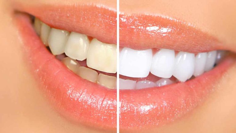 8 Ways to Whiten Teeth Naturally